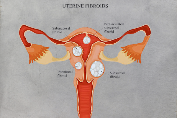 Medical illustration of the female reproductive system highlighting the presence and locations of uterine fibroids within the uterus